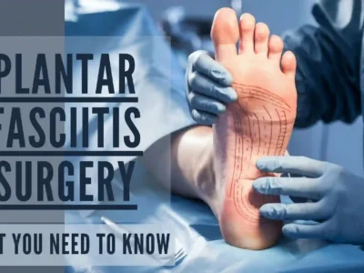 Plantar fasciitis surgery – what you need to know about surgical treatment options, recovery, and success rates for chronic foot pain relief