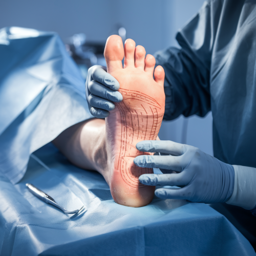 Plantar Fasciitis Surgery